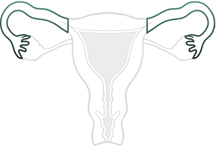 Oophorectomy