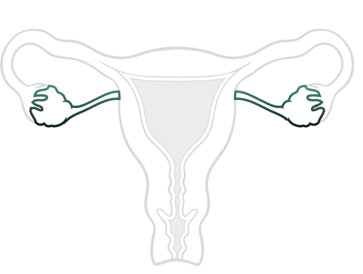 Salpingectomy