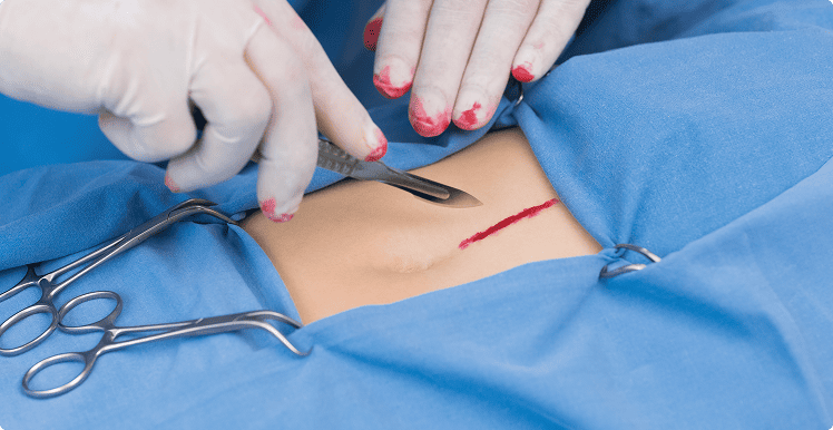 Small incision on patient skin